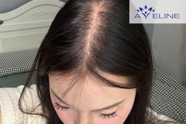 Nguyên nhân tóc mỏng 