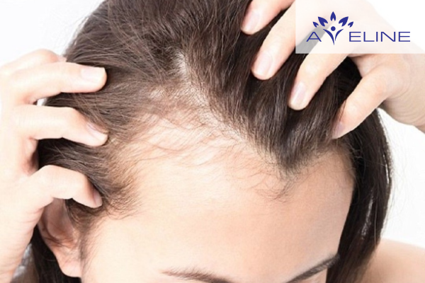 Ngứa và viêm da đầu 